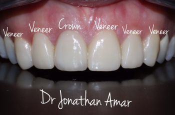 Drs Marc Amar et Jonathan Amar Cas couronnes et implants Dentiste à Nogent sur Marne 
