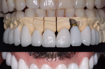 Cas couronnes et implants Dentiste à Nogent sur Marne Drs Marc Amar et Jonathan Amar